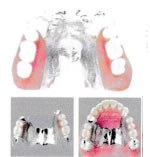 チタン床義歯