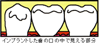 インプラントした歯の口の中で見える部分