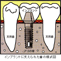 インプラントに支えられた歯の模式図
